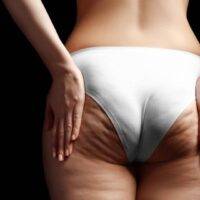 Laser treatment for Cellulite - Center Laser Cali