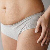 Laser treatment for Stretch marks - Laser Center Cali